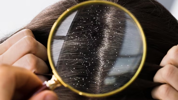 Hair Care Tips Natural Home Remedies For Dandruff That Actually Work