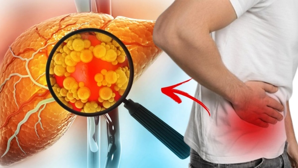 Warning Signs of Fatty Liver Disease 90 People Often Ignore