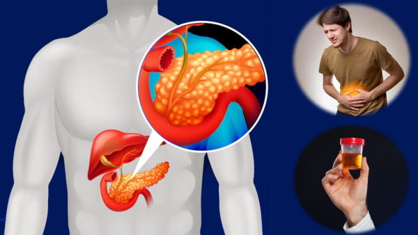 World Pancreatic Cancer Day 2025 Doctor Lists Warning Signs of Pancreatic Cancer