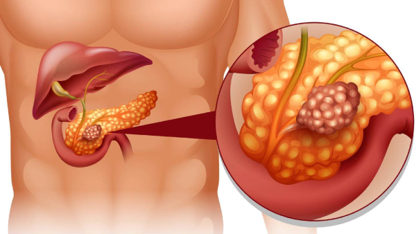 World Pancreatic Cancer Day 2025 Doctor Lists Warning Signs of Pancreatic Cancer