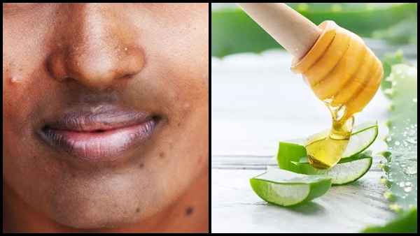 Skin Care Tips Top 10 Home Remedies to Remove Darkness Around Mouth Naturally Skin Care Tips Top 10 Home Remedies to Remove Darkness Around Mouth Naturally