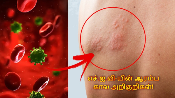 World AIDS Day 2025 Early Signs of HIV That Appear In the First Few Weeks World AIDS Day 2025 Early Signs of HIV That Appear In the First Few Weeks