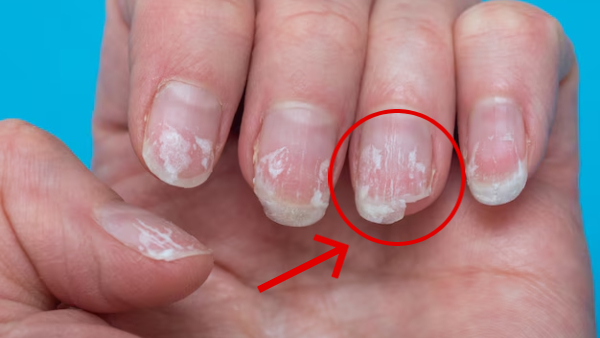 Top Five Warning Signs Your Nails Tell You Have Hypothyroidism Top Five Warning Signs Your Nails Tell You Have Hypothyroidism