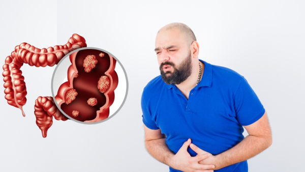 Gastroenterologist Shares 8 Warning Signs Of Colon Cancer That You Should Know