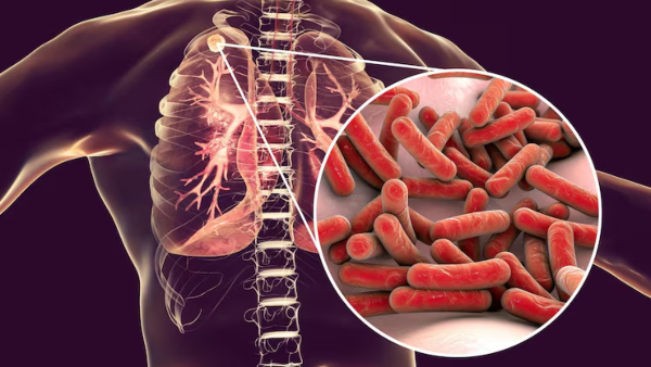 World Tuberculosis Day 2026 Know What Is Tuberculosis TB Symptoms Causes Diagnosis