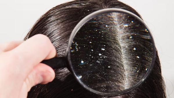 Summer Hair Care Tips Ayurvedic Doctor Shares The Best Home Remedy For Dandruff And Itchy Scalp