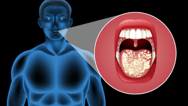 World No Tobacco Day 2026 Doctor Explains Why Non-Smokers Are Getting Oral Cancer Causes amp amp Early Warning Signs
