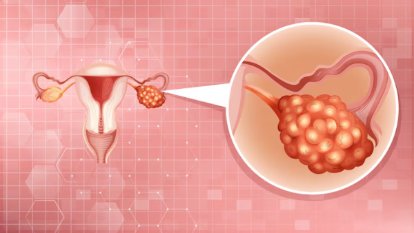 Early Warning Signs Of Ovarian Cancer In Tamil