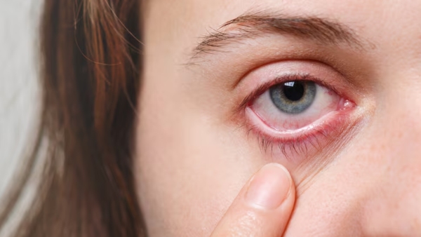 Silent Symptoms Of Fatty Liver Disease You May Notice In Your Eyes Silent Symptoms Of Fatty Liver Disease You May Notice In Your Eyes