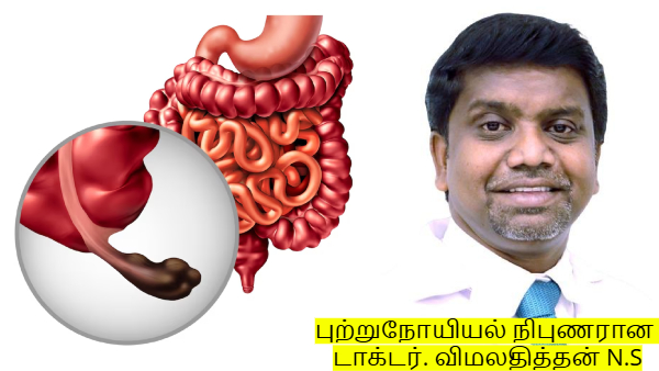 Appendix Cancer Doctor Reveals Symptoms Causes And Treatment Options
