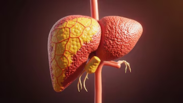 Liver Cancer Awareness Month - Fatty Liver to Liver Cancer How Serious Is the Risk Hepatologist Explains