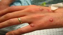 Monkeypox: కరోనా సమయంలో వణికిస్తోన్న మరో వింత వ్యాధి, లక్షణాలు, చికిత్స ఉందా??