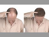 Hair Growth: మీ తలపై బట్టతల ఏర్పడిందా? ఈ హోం రెమెడీస్ మీ బట్టతలపై జుట్టు పెరిగేలా చేస్తాయి