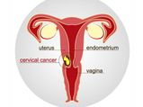Cervical Cancer Vaccine: గర్భాశయ క్యాన్సర్ కు దేశీయ టీకా.. ఇవాళ్టి నుండి అందుబాటులోకి 