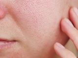 Face Pack for Pores: మీ ముఖంలో చర్మం రంద్రాలా.. వికారంగా ఉందా?ఇలా ఫేస్ ప్యాక్ వేసుకుంటే రంధ్రాలు కవర్ చేస్తాయి