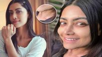 Mamta Mohandas: మమతా మోహన్‌దాస్‌కు బొల్లి వ్యాధి, ఎందుకొస్తుంది, లక్షణాలు ఏంటంటే.. 