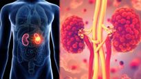 Kidney Cancer : మీకు ఈ క్రింది లక్షణాలు ఉంటే, మీకు కిడ్నీ క్యాన్సర్ వచ్చే అవకాశం ఉంది! జాగ్రత్త !