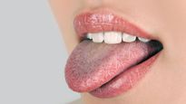 Summer Dry Mouth: ఈ ఎండాకాలంలో నోరు పొడిబారుతోందా? అయితే ఈ చిట్కాలు మీ కోసమే 