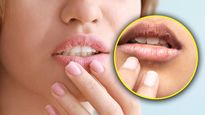 Summer Dry Lips: వేసవిలో పెదాలు పొడిబారి పగులుతున్నాయా? ఈ చిట్కాలు మీకోసమే