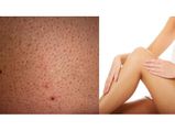 Strawberry Legs: స్ట్రాబెర్రీ లెగ్స్.. ఈ ఈజీ చిట్కాలతో సమస్య ఇట్టే పోతుంది