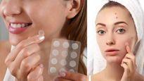 Pimple Patches: మొటిమలు ఇబ్బంది పెడుతున్నాయా? ఈ పింపుల్ ప్యాచెస్ వాడితే మచ్చలు పడకుండా తొలగిపోతాయి