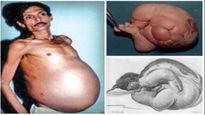 Man Pregnant: ప్రెగ్నెంట్ అయిన పురషుడు, కడుపులో కవలలు గుర్తింపు!