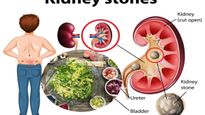 Food Habits: కిడ్నీలో రాళ్లు ఏర్పడకుండా ఉండాలంటే ఈ హెల్తీ ఫుడ్స్ తక్కువగా తినండి.!