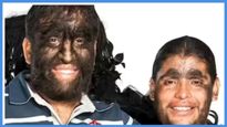 గిన్నిస్ బుక్ లో చోటో సంపాధించిన Werewolf syndrome కుటుంబం మొత్తం.! చూస్తే షాకే మరి..