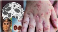 Monkeypox వైరస్: కరోనా తర్వాత మంకీపాక్స్ ప్రబలుతోంది,  జననాంగాలలో ఈ భయంకరమైన మార్పు