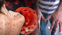 Mpox Outbreak:మంకీపాక్స్‌కు సంబంధించి ఢిల్లీ ఎయిమ్స్ మార్గదర్శకాలు లక్షణాలు కనిపించిన వెంటనే ఈ పనులు చేయండి