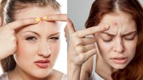 Pimples on Forehead: నుదిటిపై తరచుగా మొటిమలు వస్తున్నాయా? శరీరంలోని ఆ భాగం ప్రమాదంలో!