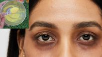 ఇది ఒక్క చుక్క రాసుకుంటే చాలు, క్షణంలోనే డార్క్ సర్కిల్స్ మాయమైపోతాయి.. అందరి ఇంట్లో ఉంటుంది!