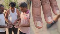 వామ్మో ఇండియాలో అతి భయంకరమైన వింత వ్యాధి.. లక్షణాలు ఎలా ఉంటాయంటే?