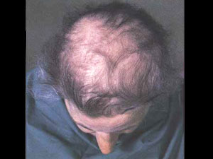 మందులతో జుట్టు ఊడిపోకుండా చూడొచ్చు