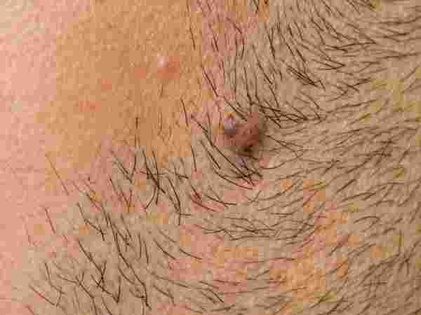 బాడీ వ్యాక్సింత్ వల్ల దుష్ప్రభావాలు