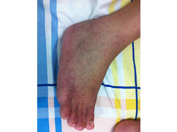 వర్షాకాలంలో బాధించే జబ్బులు-నివారణ