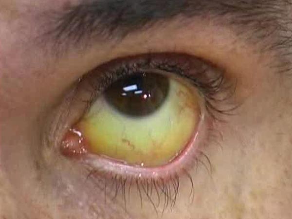 కామెర్లు 