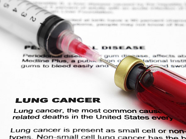 అపోహ: కేవలం పొగతాగే అలవాటు గలవారికి మాత్రమే వూపిరితిత్తుల క్యాన్సర్‌ వస్తుంది.