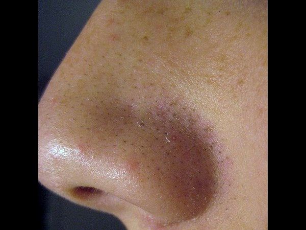 5. నిమ్మ తేనె బ్లాక్ హెడ్ రిమూవర్