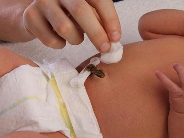 Caring For Your Newborn's Umbilical Cord 