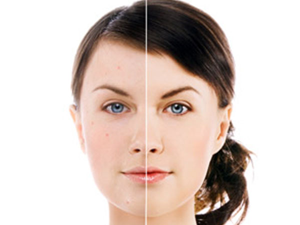 స్కార్స్ ను తొలగిస్తుంది