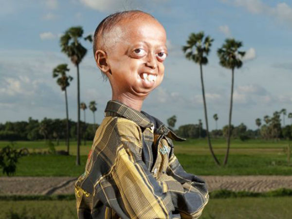 ప్రొగేరియా