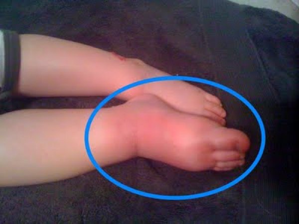 సిరల లోపం