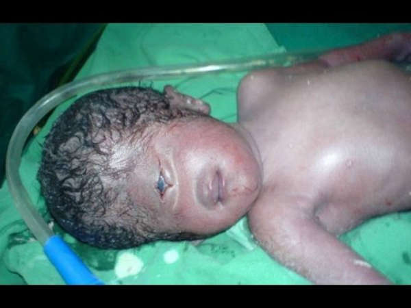 ఒకే కన్ను