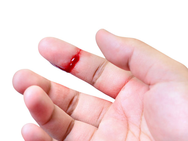 తెగిన గాయాల నుండి రక్తస్రావాన్ని తగ్గిస్తుంది: