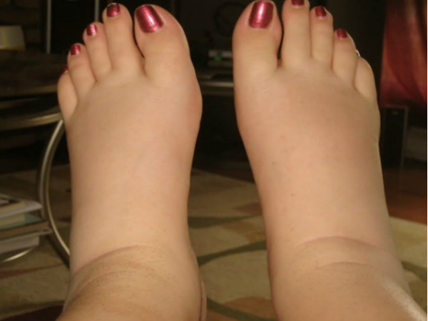 పాదాలు వాపులు