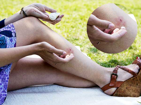 కీటకాలు కుట్టిన గాయాలను మాన్పుతుంది: 