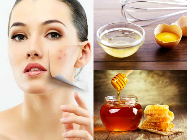  మొటిమల నివారణకు : 