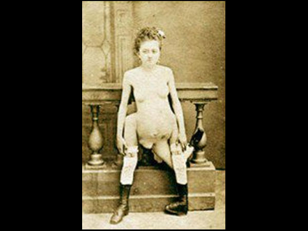 Born With 3 Legs, 4 Breasts & 2 Vaginas