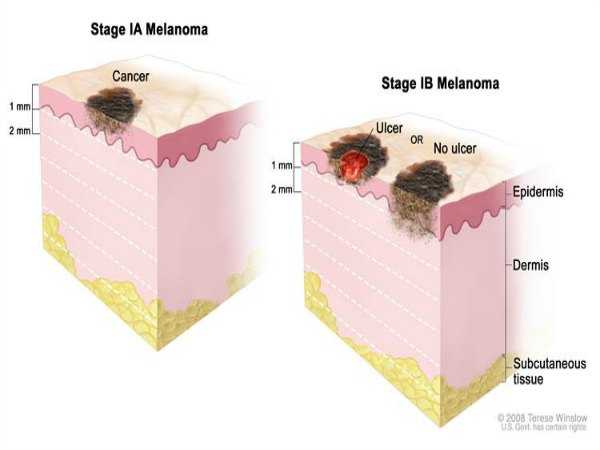The Complete Guide to Melanoma: Symptoms